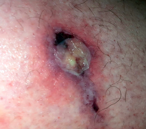 Recluse Bite